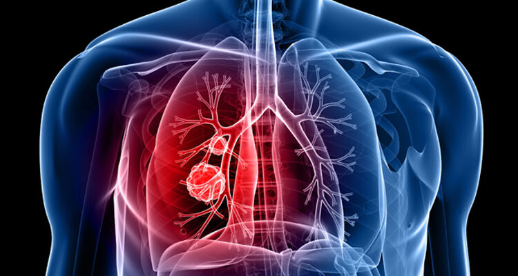 وافقت هيئة الغذاء والدواء الأمريكية لشركة نوفارتس على عقار «Tabrecta» لعلاج المرضى البالغين المصابين بسرطان الرئة ذي الخلايا غير الصغيرة «NSCLC» الذي انتشر إلى أجزاء أخرى من الجسم.