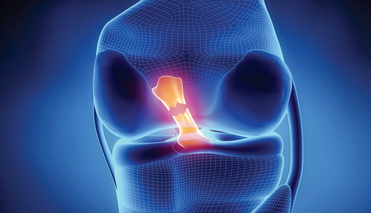 تمزق الرباط الصليبي